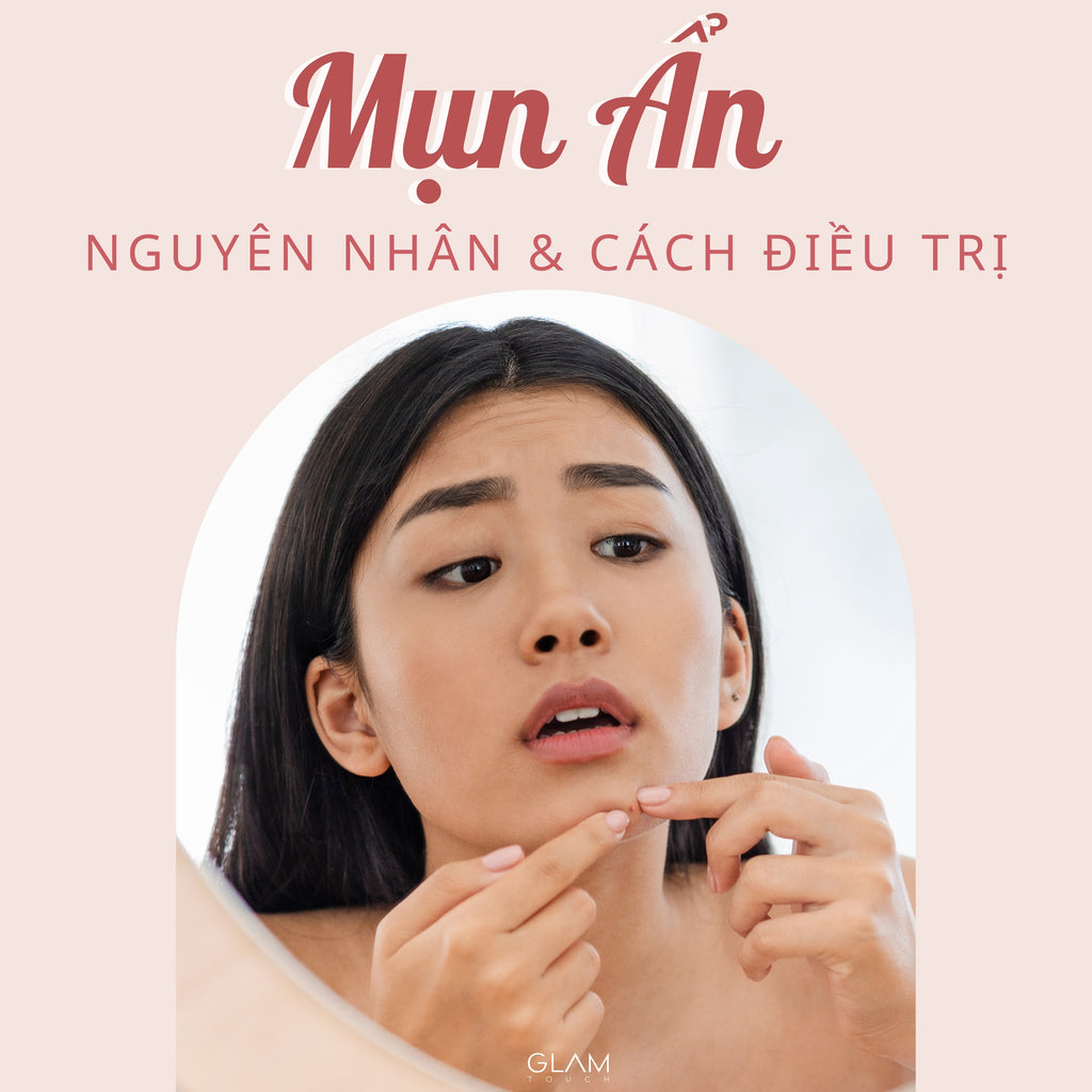 Mụn Ẩn Dưới Da: Nguyên Nhân và Cách Điều Trị Hiểu Quả